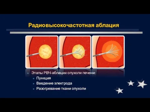 Радиовысокочастотная аблация Этапы РВЧ-аблации опухоли печени: Пункция Введение электрода Разогревание ткани опухоли