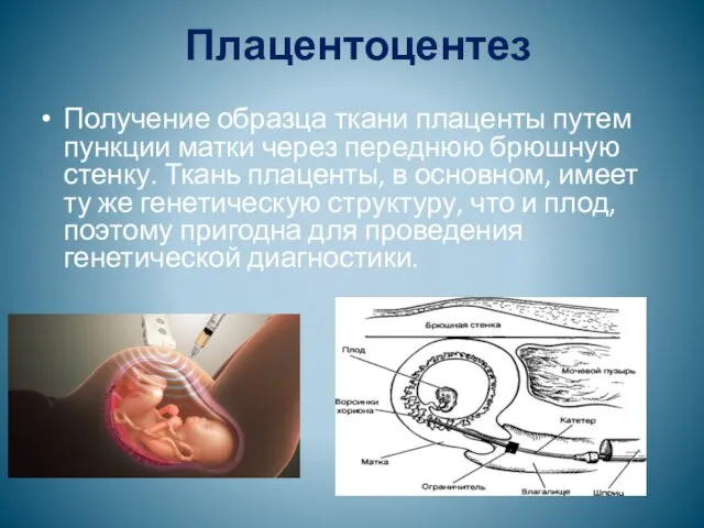 Плацентоцентез Получение образца ткани плаценты путем пункции матки через переднюю