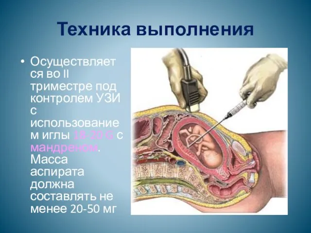 Техника выполнения Осуществляется во II триместре под контролем УЗИ с