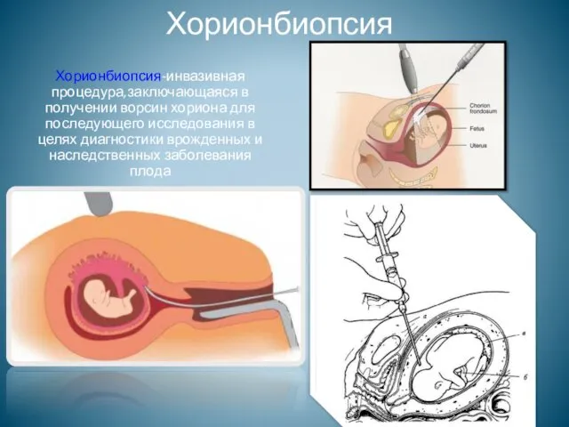 Хорионбиопсия Хорионбиопсия-инвазивная процедура,заключающаяся в получении ворсин хориона для последующего исследования