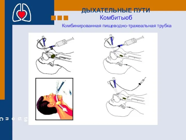 ДЫХАТЕЛЬНЫЕ ПУТИ Комбитьюб Комбинированная пищеводно-трахеальная трубка