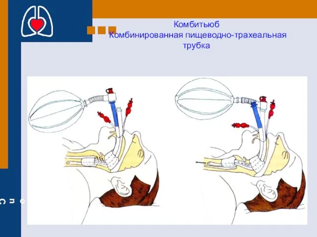 Комбитьюб Комбинированная пищеводно-трахеальная трубка