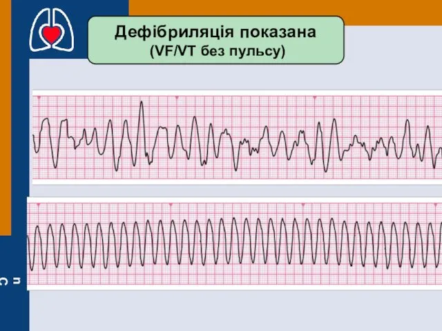 Дефібриляція показана (VF/VT без пульсу)