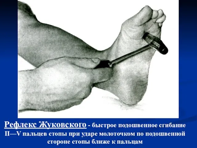 Рефлекс Жуковского - быстрое подошвенное сгибание II—V пальцев стопы при