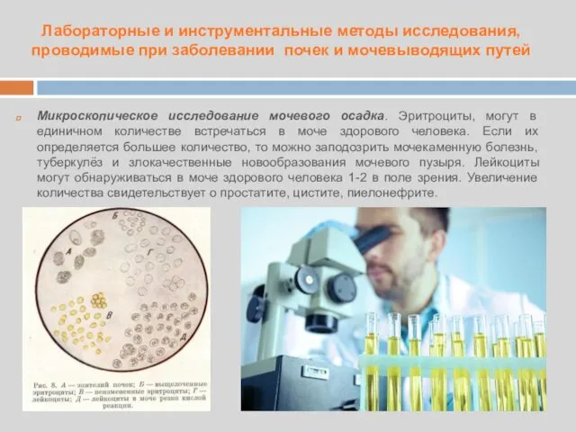 Микроскопическое исследование мочевого осадка. Эритроциты, могут в единичном количестве встречаться