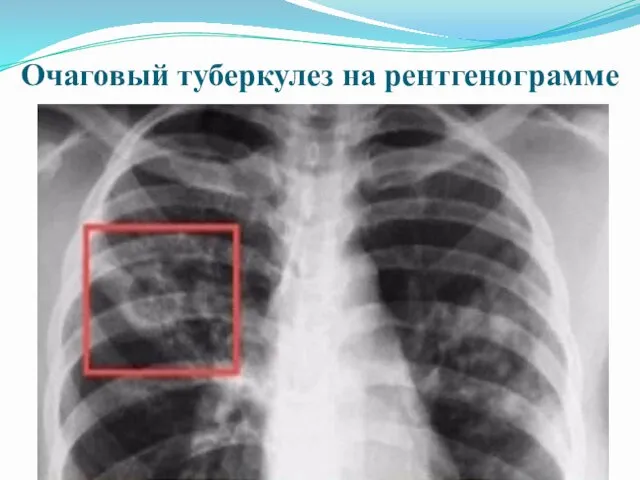 Очаговый туберкулез на рентгенограмме