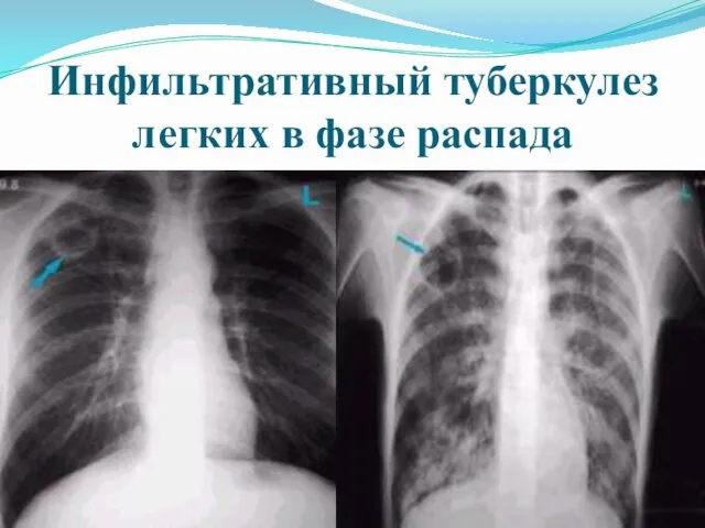 Инфильтративный туберкулез легких в фазе распада