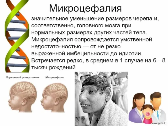 Микроцефалия значительное уменьшение размеров черепа и, соответственно, головного мозга при