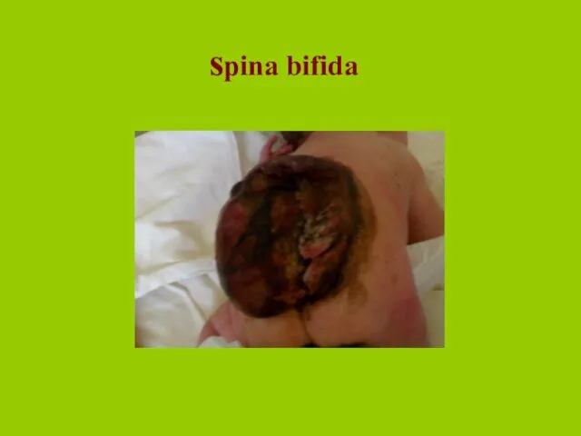 spina bifida