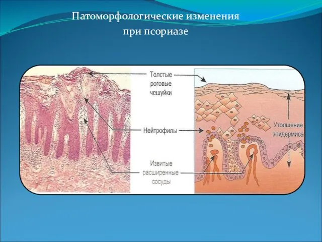 Патоморфологические изменения при псориазе