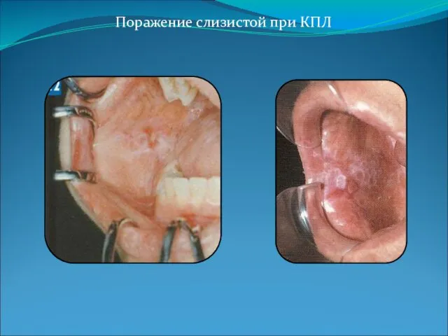 Поражение слизистой при КПЛ