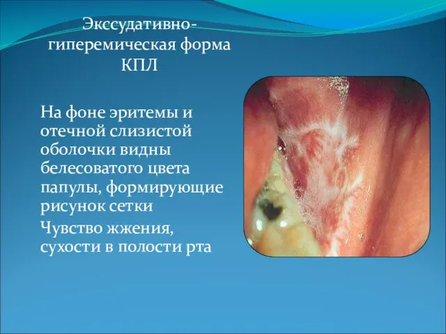 Экссудативно-гиперемическая форма КПЛ На фоне эритемы и отечной слизистой оболочки