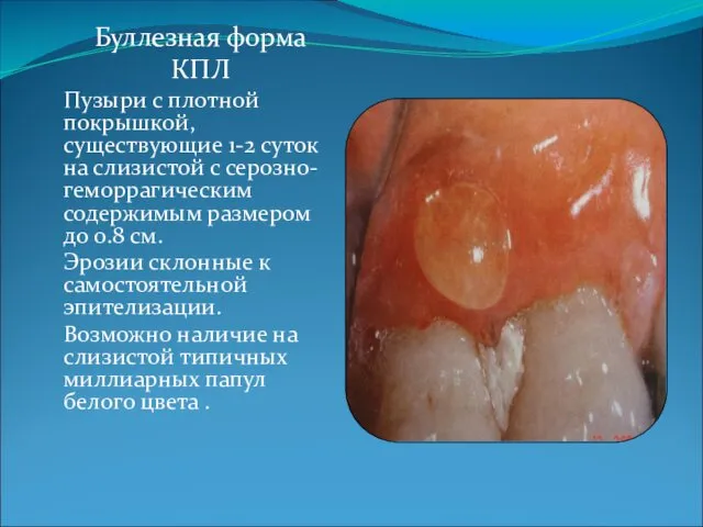 Буллезная форма КПЛ Пузыри с плотной покрышкой, существующие 1-2 суток