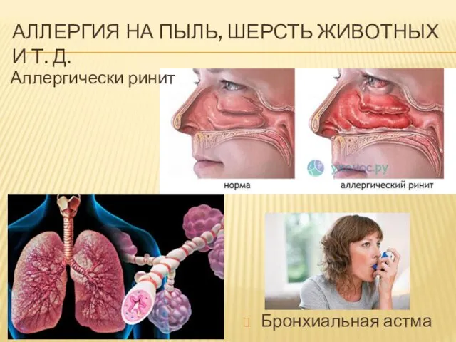 АЛЛЕРГИЯ НА ПЫЛЬ, ШЕРСТЬ ЖИВОТНЫХ И Т. Д. Аллергически ринит Бронхиальная астма