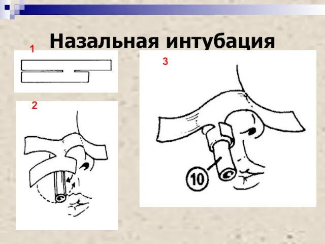 Назальная интубация 1 2 3