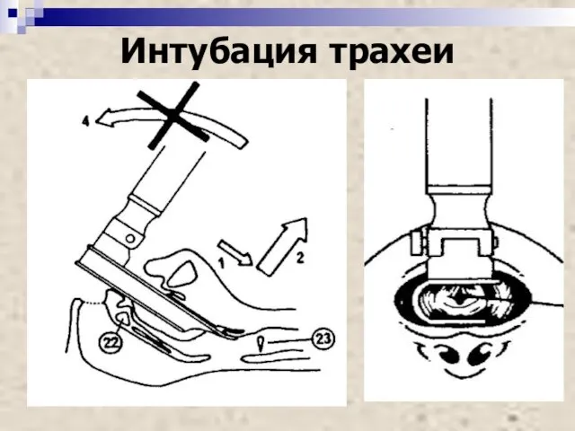 Интубация трахеи