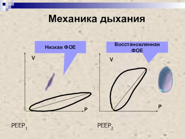 P V V P Механика дыхания PEEP1 PEEP2