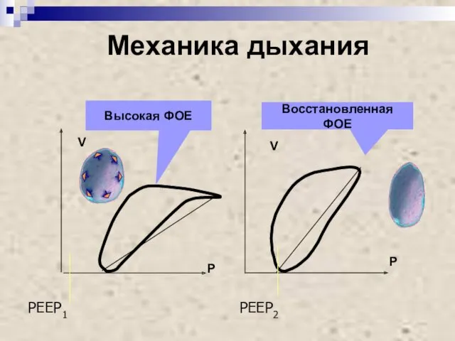 P V V P Механика дыхания PEEP1 PEEP2