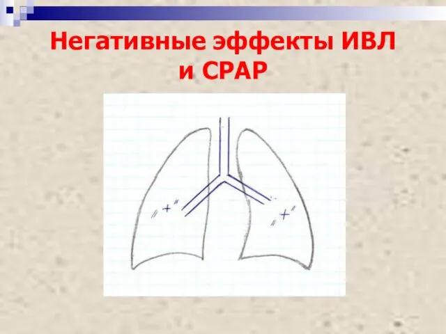 Негативные эффекты ИВЛ и СРАР