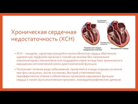 Хроническая сердечная недостаточность (ХСН) ХСН – синдром, характеризующийся неспособностью сердца обеспечить адекватную перфузию
