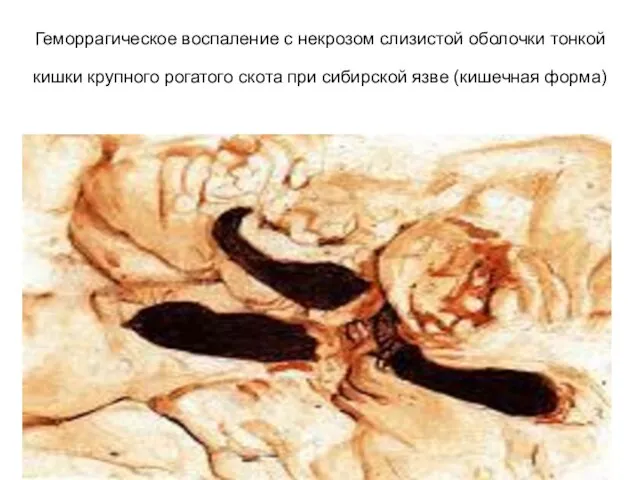 Геморрагическое воспаление с некрозом слизистой оболочки тонкой кишки крупного рогатого скота при сибирской язве (кишечная форма)