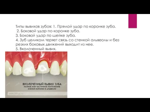 Типы вывихов зубов: 1. Прямой удар по коронке зуба. 2. Боковой удар по