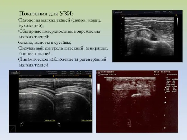 Показания для УЗИ: Патология мягких тканей (связок, мышц, сухожилий); Обширные