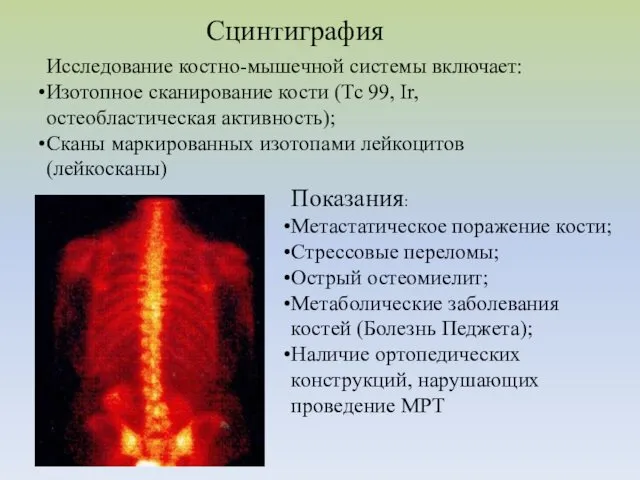 Сцинтиграфия Исследование костно-мышечной системы включает: Изотопное сканирование кости (Тс 99,