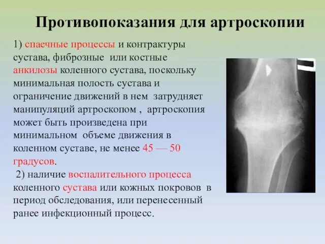 Противопоказания для артроскопии 1) спаечные процессы и контрактуры сустава, фиброзные