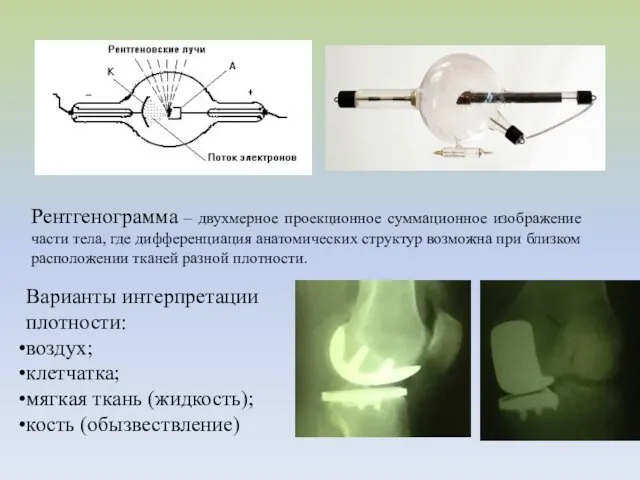 Рентгенограмма – двухмерное проекционное суммационное изображение части тела, где дифференциация