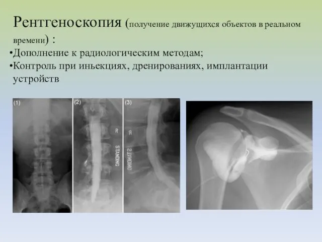 Рентгеноскопия (получение движущихся объектов в реальном времени) : Дополнение к