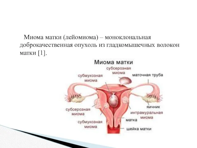 Миома матки (лейомиома) – моноклональная доброкачественная опухоль из гладкомышечных волокон матки [1].