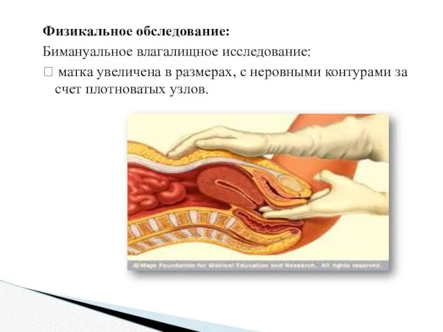 Физикальное обследование: Бимануальное влагалищное исследование:  матка увеличена в размерах,