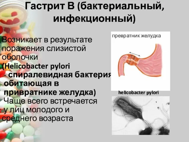 Гастрит В (бактериальный, инфекционный) Возникает в результате поражения слизистой оболочки (Helicobacter pylori -