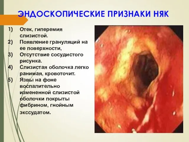 ЭНДОСКОПИЧЕСКИЕ ПРИЗНАКИ НЯК Отек, гиперемия слизистой. Появление грануляций на ее