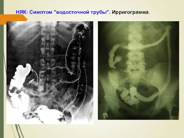 НЯК: Симптом "водосточной трубы". Ирригограмма.