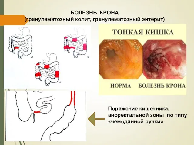 БОЛЕЗНЬ КРОНА (гранулематозный колит, гранулематозный энтерит) Поражение кишечника, аноректальной зоны по типу «чемоданной ручки»