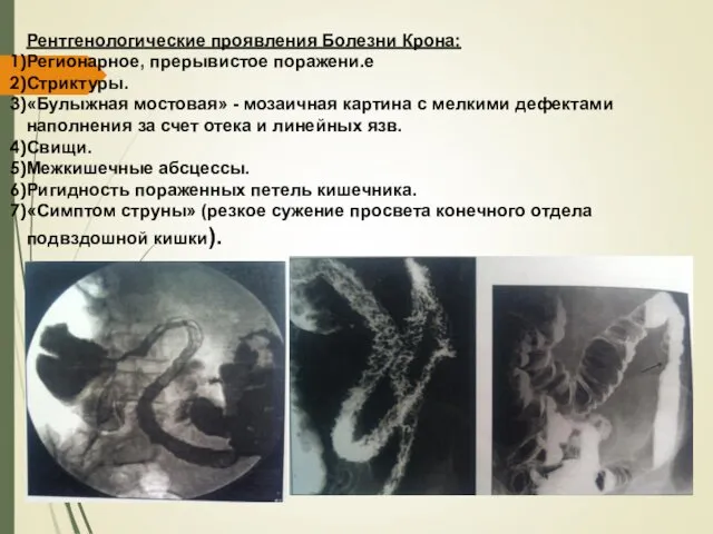 Рентгенологические проявления Болезни Крона: Регионарное, прерывистое поражени.е Стриктуры. «Булыжная мостовая»