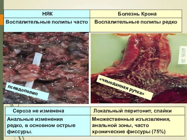 «чемоданная ручка» псевдополип