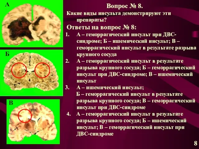 А Б В 8 Вопрос № 8. Какие виды инсульта