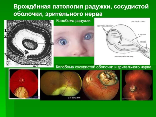 Врождённая патология радужки, сосудистой оболочки, зрительного нерва Колобома сосудистой оболочки и зрительного нерва