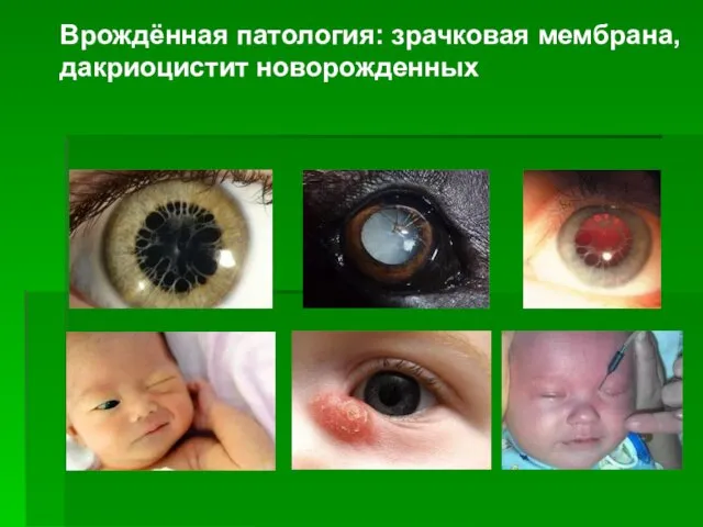 Врождённая патология: зрачковая мембрана, дакриоцистит новорожденных