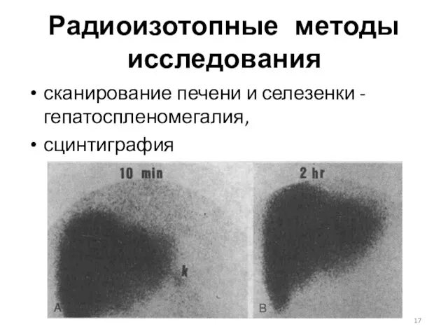 Радиоизотопные методы исследования сканирование печени и селезенки - гепатоспленомегалия, сцинтиграфия