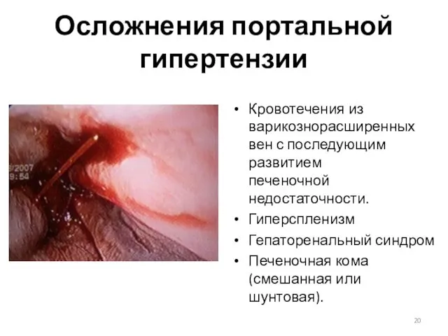 Осложнения портальной гипертензии Кровотечения из варикознорасширенных вен с последующим развитием печеночной недостаточности. Гиперспленизм