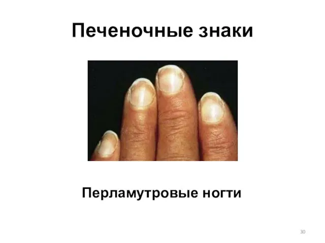 Печеночные знаки Перламутровые ногти