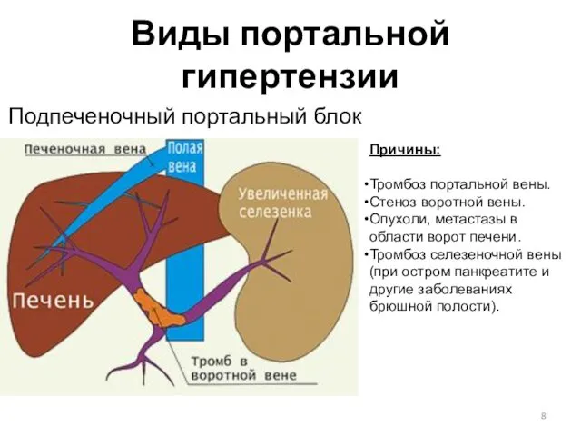 Виды портальной гипертензии Подпеченочный портальный блок Причины: Тромбоз портальной вены. Стеноз воротной вены.