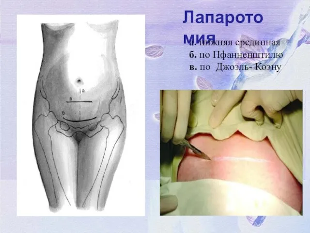 Лапаротомия а. нижняя срединная б. по Пфанненштилю в. по Джоэль- Коэну