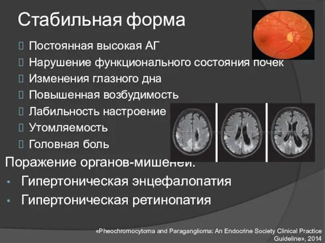 Стабильная форма Постоянная высокая АГ Нарушение функционального состояния почек Изменения