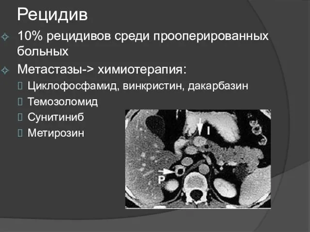 Рецидив 10% рецидивов среди прооперированных больных Метастазы-> химиотерапия: Циклофосфамид, винкристин, дакарбазин Темозоломид Сунитиниб Метирозин