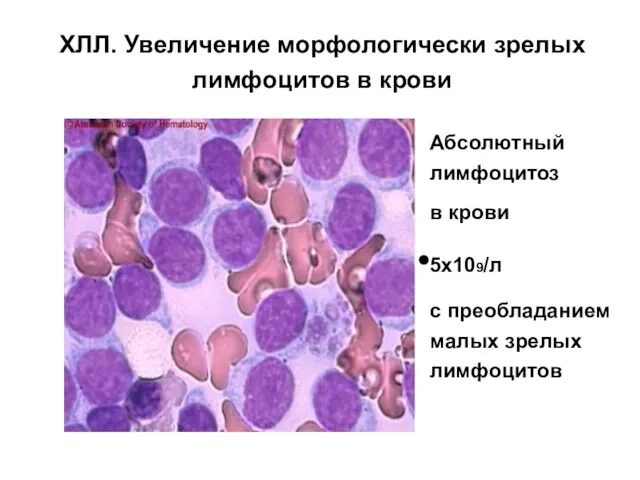 ХЛЛ. Увеличение морфологически зрелых лимфоцитов в крови Абсолютный лимфоцитоз в